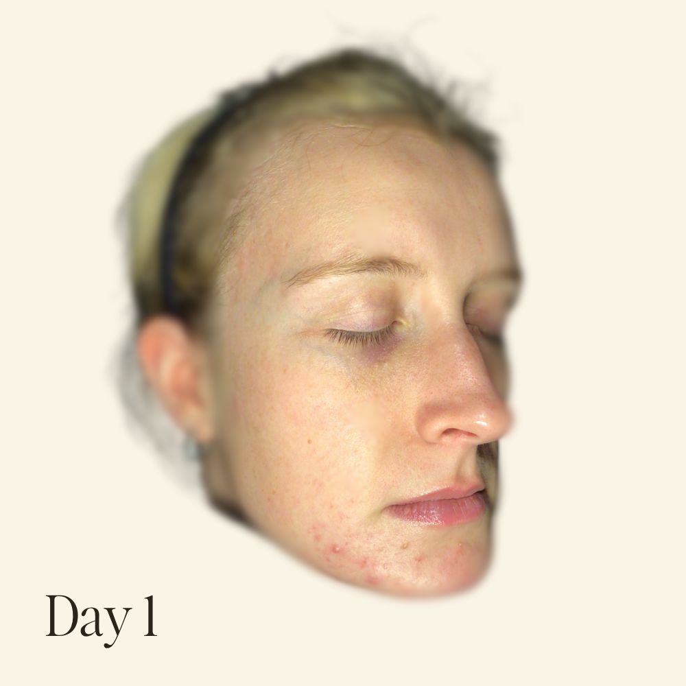 Genaura levagen+ Results Reduction of breakouts & irritation Shrink 1